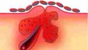 北大倡导科学祛痘 让青春不再有“痘”留-lni