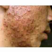 兰州祛痘医生详解长痘痘的原因-lni