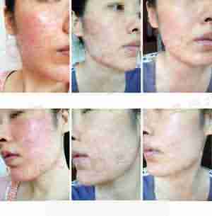 北大生物共振过敏源检测系统 快速止痒根治过敏-lni