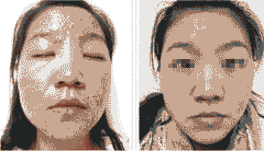 了解青春痘的症状 对症治疗是关键-lni