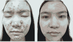 了解青春痘的症状 对症治疗是关键-lni