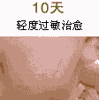 影响荨麻疹治疗费用的因素-lni