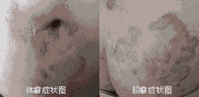 兰州北大中西医综合治疗 扫除皮肤癣效果好-lni