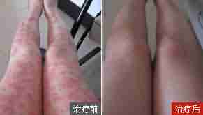 中医净血抗癣疗法 根治顽癣不复发-lni