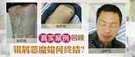 治疗牛皮癣 兰州北大是您的正规佳选择-lni