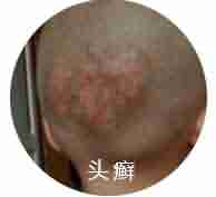 ����ҽ��������ʶƤ��Ѣ��֢״-lni