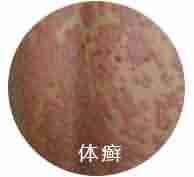 ����ҽ��������ʶƤ��Ѣ��֢״-lni