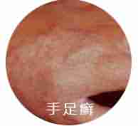 ����ҽ��������ʶƤ��Ѣ��֢״-lni