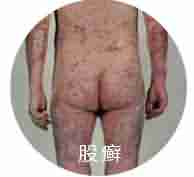 ����ҽ��������ʶƤ��Ѣ��֢״-lni