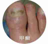 ����ҽ��������ʶƤ��Ѣ��֢״-lni