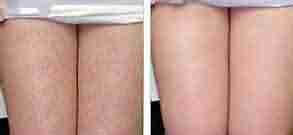 正规医生解析鸡皮肤的临床表现-lni