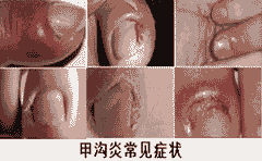 皮肤科医生介绍,甲沟炎的危害和治疗方法-lni