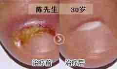 皮肤科医生介绍,甲沟炎的危害和治疗方法-lni