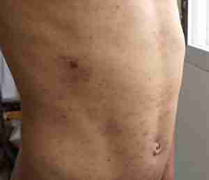 高分子生物组合 科学治疥疮-lni