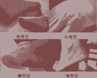 手足癣怎么治-lni