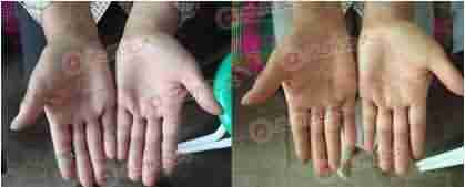 【症状】医生解读手足癣五大症状-lni