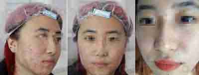 北大中西结合祛痘 直击发病根源 根治痘痘-lni