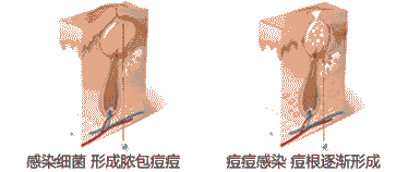 兰州祛痘医生详解长痘痘的原因-lni