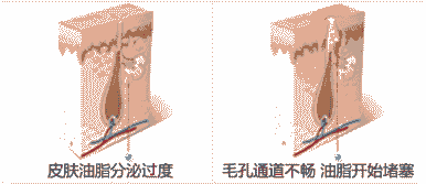 兰州祛痘医生详解长痘痘的原因-lni