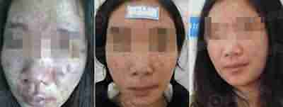 医生解析:青春痘的危害有哪些-lni