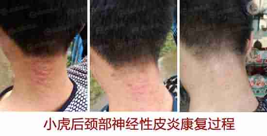 中西医结合疗法 治疗神经性皮炎效果好-lni