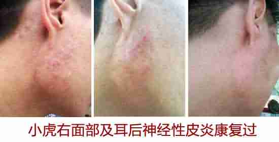 中西医结合疗法 治疗神经性皮炎效果好-lni