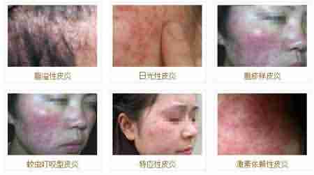 北大医生深度解析皮炎发病原因-lni