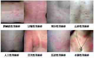 治荨麻疹!北大中医特色辩证诊疗,止痒抗敏-lni