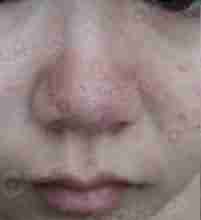 治疗酒糟鼻什么方法效果好?-lni