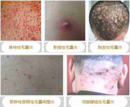 【治疗】小毛囊大问题 及时治疗很关键-lni