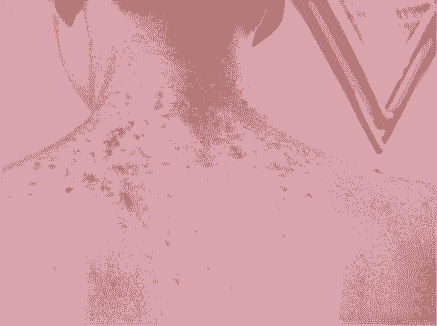 【治疗】小毛囊大问题 及时治疗很关键-lni