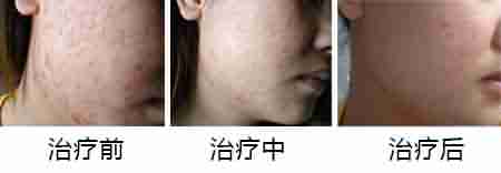 扁平疣越抓多,越抓严重-lni