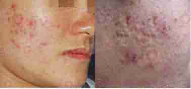 青春痘治不好 花1块钱都不值-lni