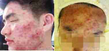 青春痘治不好 花1块钱都不值-lni