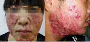 青春痘治不好 花1块钱都不值-lni