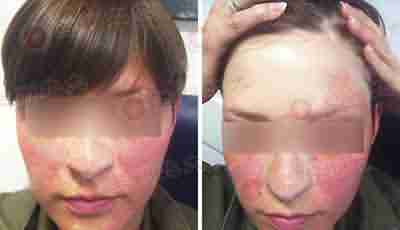 日光皮炎治疗一定要谨慎-lni