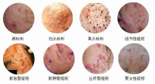 脸上长疙瘩是什么原因?-lni