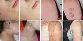 �����������Ӱ̺��޸���ϵ ȥ�̲����ۼ�-lni