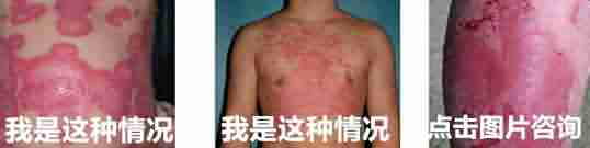 牛皮癣有哪些明显特征-lni