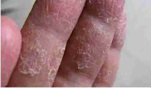 ����ҽ���������Ƥ����ô����-lni