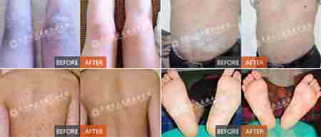 ����ҽ��������ʶƤ��Ѣ��֢״-lni