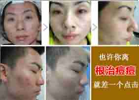 【疑问】脸上长痘痘怎么办-lni