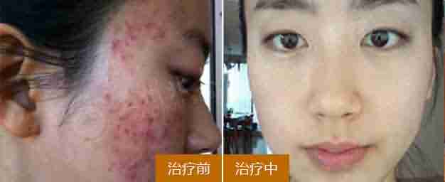 【疑问】脸上长痘痘怎么办-lni