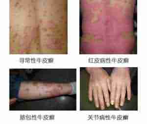 中医净血抗癣疗法 根治顽癣不复发-lni