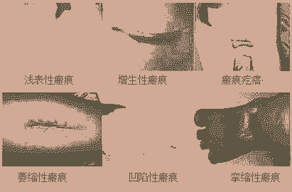 疤痕产生的原因是什么-lni