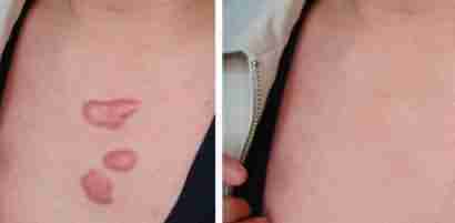 疤痕产生的原因是什么-lni