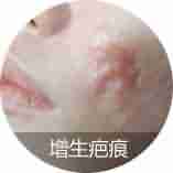 【揭秘】疤痕的症状类型有哪些-lni