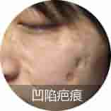【揭秘】疤痕的症状类型有哪些-lni