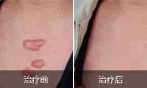 【揭秘】疤痕的症状类型有哪些-lni