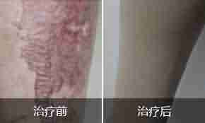 【揭秘】疤痕的症状类型有哪些-lni